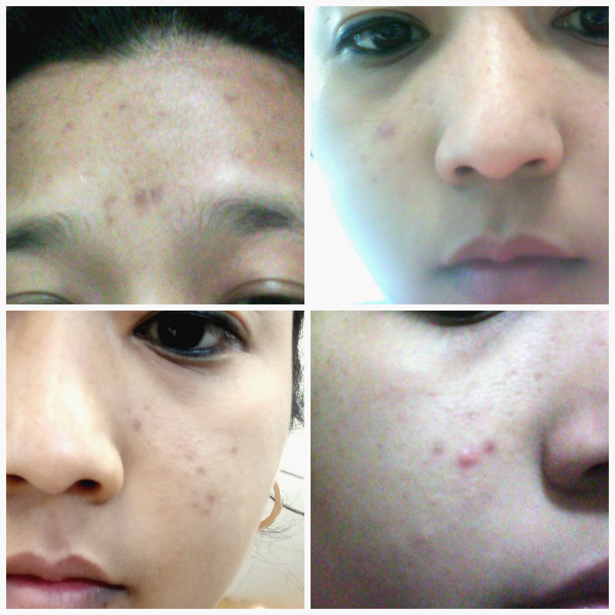 How I cleared my acne with 1 product | Skincare Tips